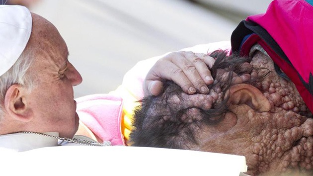 Fotos: El emotivo abrazo del papa Francisco a un hombre con deformaciones en la piel