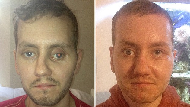 Médicos británicos restauran el rostro de un paciente mediante una impresora 3D
