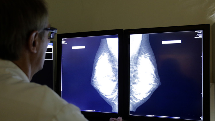 ¿Es posible destruir tumores en 11 días? Revelan nuevo método para luchar contra el cáncer de mama