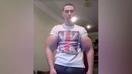 Le extraen los músculos de Synthol al 'hulk ruso' y se los cambian por implantes de silicona
