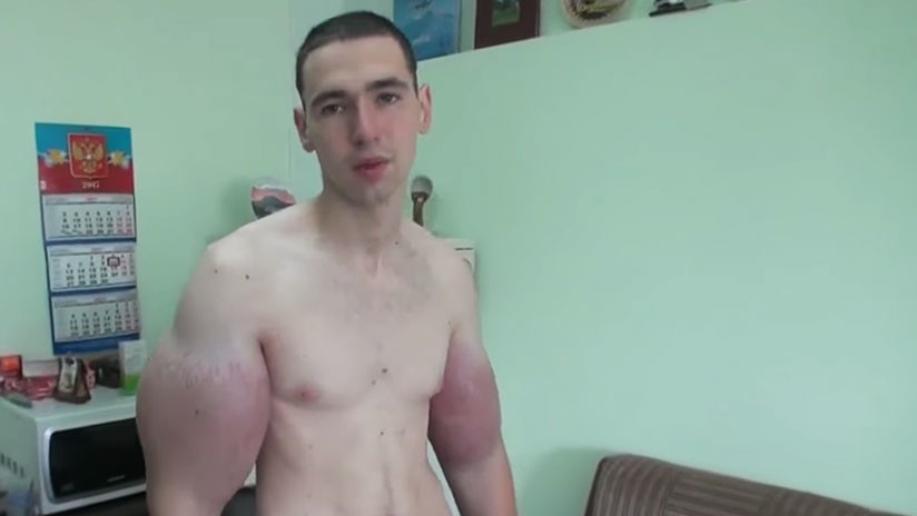 "Pido a Dios la muerte": El 'hulk' ruso dice que ya no aguanta el dolor en los brazos