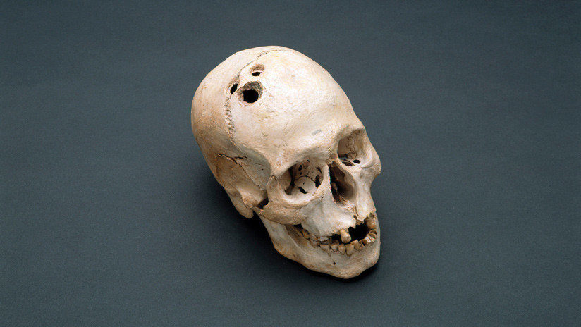 Los incas fueron mejores en cirugías de cráneo que los médicos de la Guerra Civil Americana