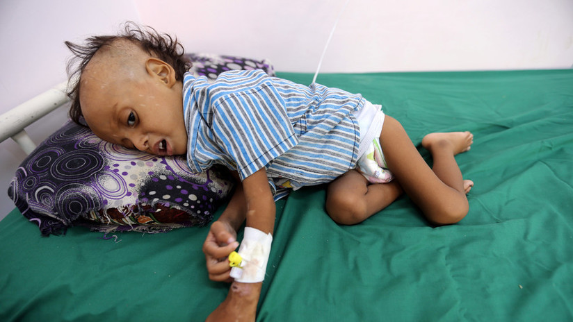 85.000 niños de menos de 5 años murieron por desnutrición desde el inicio de la guerra en Yemen 