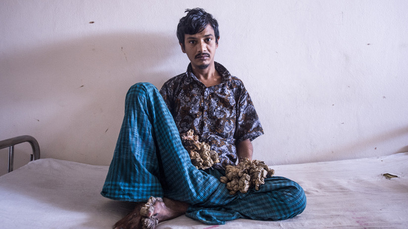 "No puedo soportar más el dolor": El 'hombre árbol' de Bangladés pide que le amputen las manos 