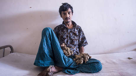 "No puedo soportar más el dolor": El 'hombre árbol' de Bangladés pide que le amputen las manos
