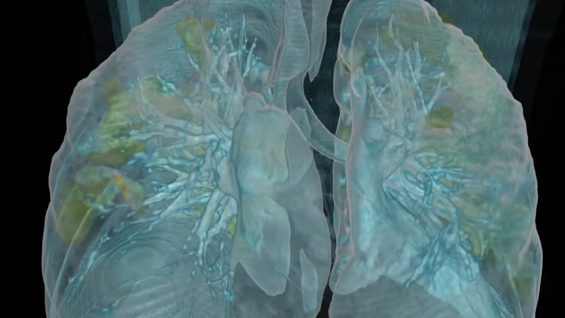 Un video muestra los efectos del covid-19 sobre unos pulmones sanos