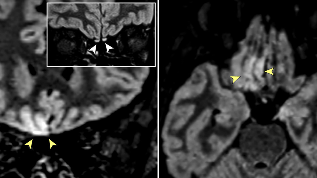 Imágenes de resonancia magnética muestran signos de "invasión cerebral viral" en una paciente con covid-19