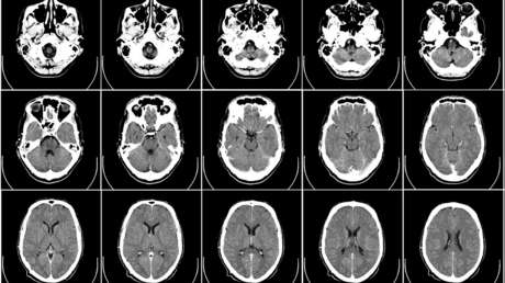 Un aficionado a la jardinería contrae de la tierra de una maceta una infección mortal que le 'disolvió' el cerebro