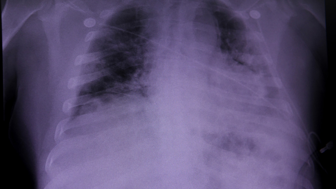 Identifican daños pulmonares que podrían estar asociados a un síndrome conocido como 'covid largo'