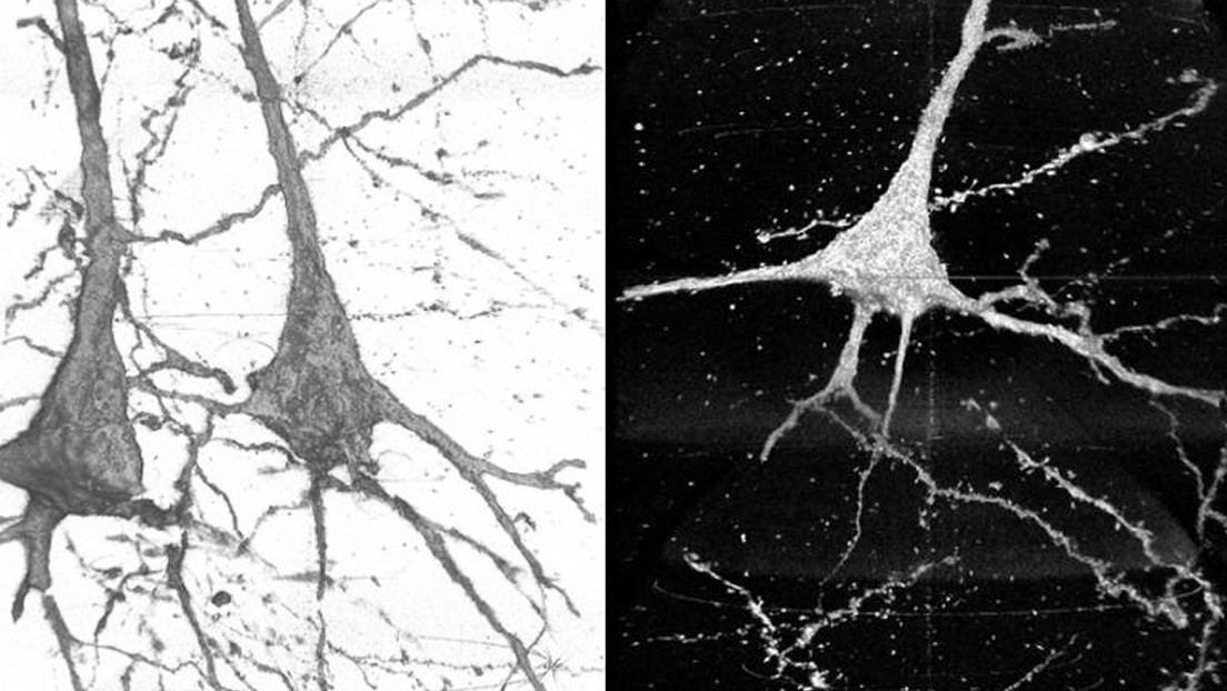 Científicos descubren algunas diferencias neuronales entre personas sanas y pacientes esquizofrénicos
