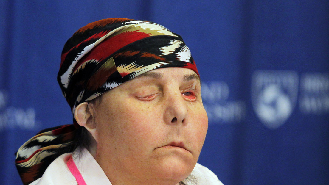 La primera persona en recibir dos trasplantes de cara en EE.UU. muestra su rostro (FOTO)