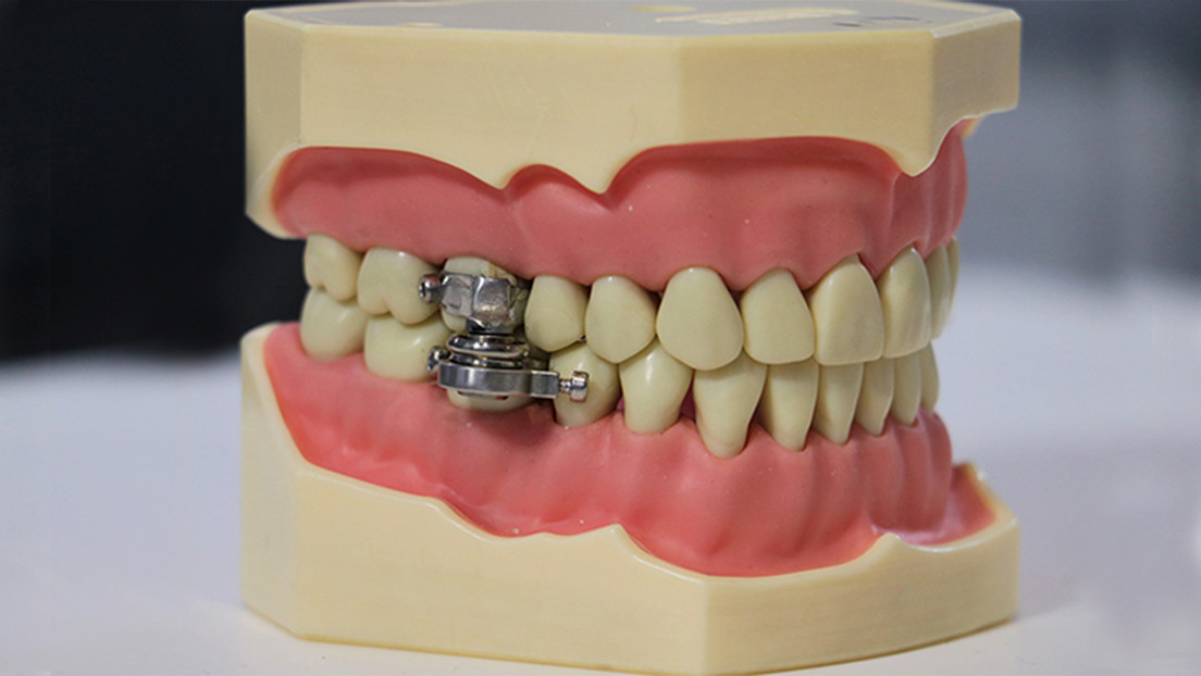 Presentan el "primer dispositivo del mundo para adelgazar" cerrando los dientes con un 'candado' (VIDEO)
