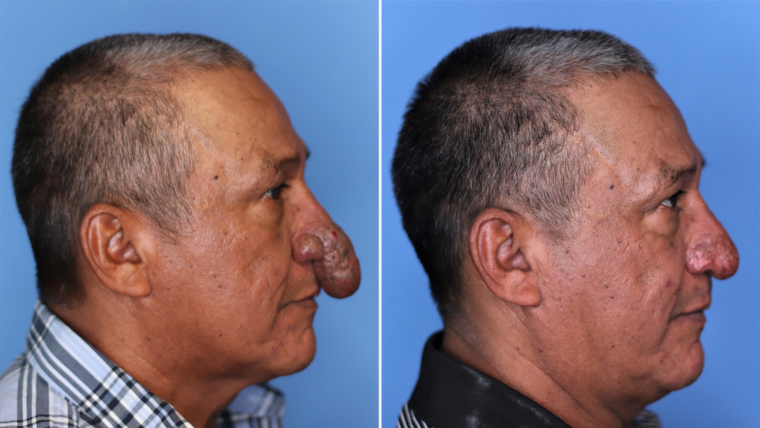 Un cirujano plástico le regala una reconstrucción facial a un obrero que trabajaba en su casa al ver que tenía una rara malformación en la nariz