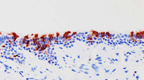 La variante ómicron se multiplica 70 veces más rápido en los bronquios que la delta pero la infección pulmonar es mucho menor, revela un estudio