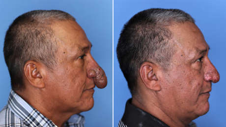 Un cirujano plástico le regala una reconstrucción facial a un obrero que trabajaba en su casa al ver que tenía una rara malformación en la nariz