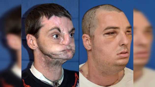 Nueva cara: realizan el trasplante de rostro más extenso del mundo