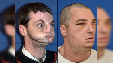 Nueva cara: realizan el trasplante de rostro más extenso del mundo