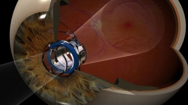 Crean un telescopio ocular para devolver la visión a personas con degeneración macular