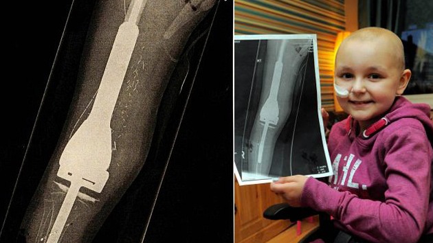 Una niña camina por primera vez tras reconstruir su pierna con 'huesos' de acero