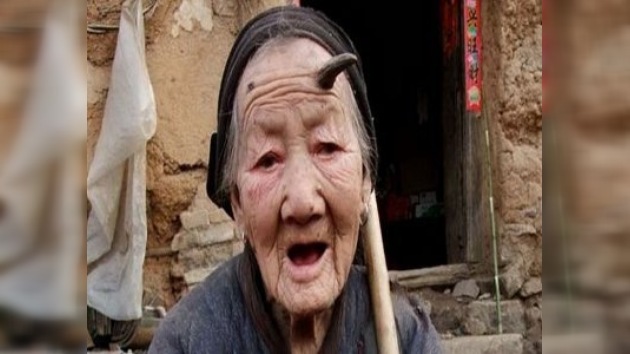 A una anciana china de 101 años le crece un cuerno de seis centímetros