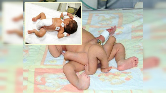 El bebé que nació con seis piernas se recupera tras la operación