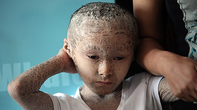 Una extraña condición hace que un niño tenga la piel cubierta de escamas