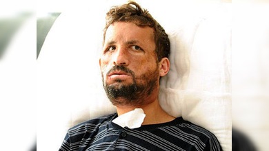 Turquía pone rostro al transplante de cara: el primer paciente operado se mira al espejo