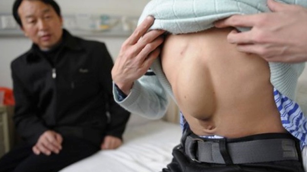 Un joven chino ha sobrevivido 24 años con el corazón en el abdomen