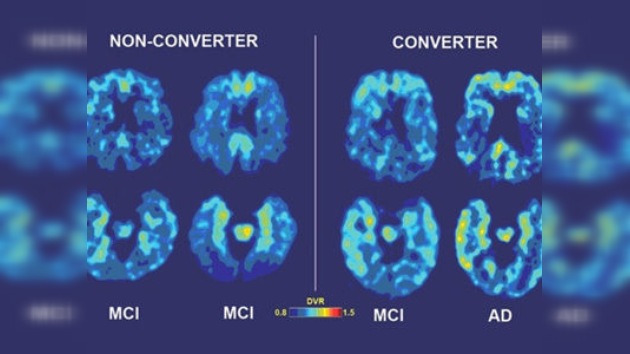 Desarrollan nueva tecnología para predecir el Alzheimer