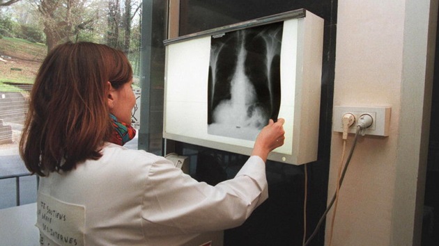 Crean por primera vez pulmones humanos en un laboratorio