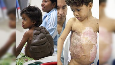 La increíble recuperación del 'niño tortuga'