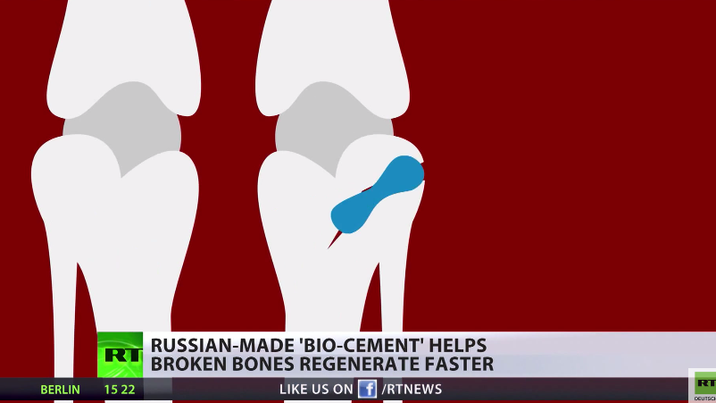 Gips adieu - Russischer Wissenschaftler erfindet regenerativen, bahnbrechenden „Knochenmörtel“