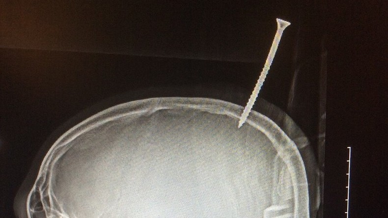 Junge überlebt 15 Zentimeter lange Schraube im Kopf [FOTOS]