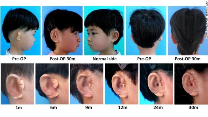 Neues Ohr aus dem Labor: Wissenschaftler züchten Ohrmuscheln für Kinder mit Fehlbildung