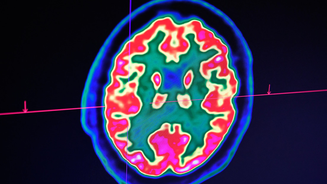 Studie: "Zombie-Zellen" werden im Gehirn nach dem Ableben aktiv