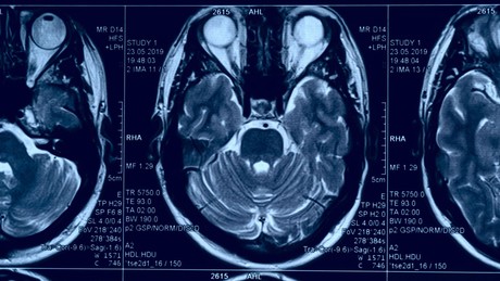 Mysteriöse neurologische Krankheit bei jungen Erwachsenen in Kanada
