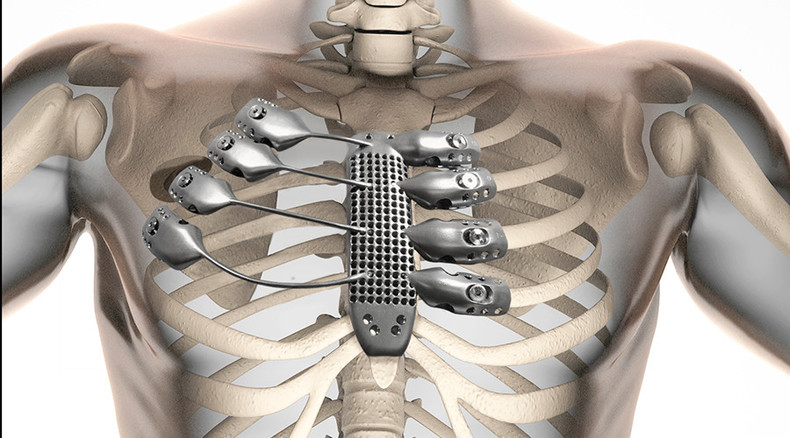 Patient gets 3D-printed metal ribs for the first time ever