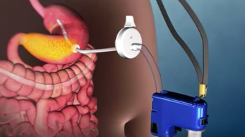 Bizarre stomach-pumping device approved in US for fighting obesity (VIDEO)