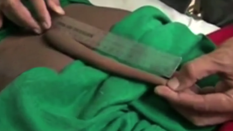 Human tail gets the chop: Teenager has 7-inch growth removed (VIDEO)