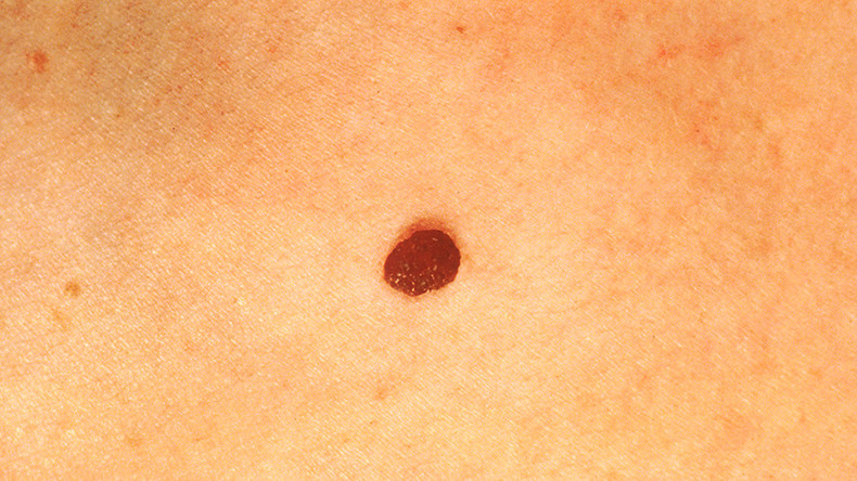 ‘Eureka moment’: AI software programmed to spot skin cancer by checking pics of moles