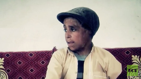 Meet Hameed: 12yo Yemeni boy is battling cholera after having 23 surgeries & losing arm (GRAPHIC)