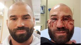 Artem Lobov shows off gruesome scars of war after debut Bare Knuckle win (GRAPHIC)