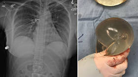 Breast case scenario: Implants stop bullet from killing woman in miraculous case (PHOTOS)