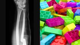 Lego for bones? Scientists develop method for repairing fractures using 3D-printed bricks inspired by popular toy