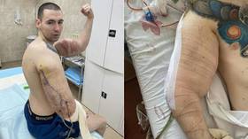 ‘Saving my life from this poison’: Russian MMA flop ‘Bazooka arms’ shows horror scars after removing bicep enhancers