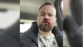 HIV-positive blogger has nose broken in broad daylight street attack after interview about challenges of life with virus in Russia