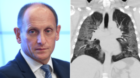 People getting more Covid scans leads to more lung cancers being detected – 1st Russian Honorary Fellow of top US surgical society