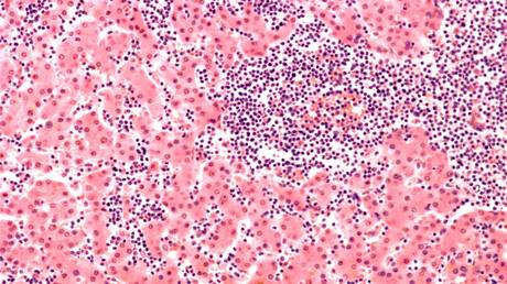 FILE PHOTO: Light micrograph of blood cells (dark purple) in the liver of a patient with lymphocytic leukemia.