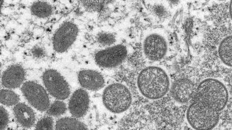 FILE PHOTO: An electron microscope image shows monkeypox virions obtained from a human skin sample.