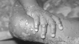 First monkeypox quarantine ordered in EU